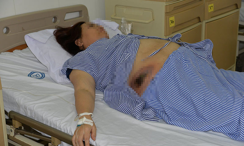 Áp xe thành bụng vì đắp thuốc nam