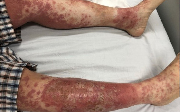 Tổn thương của bệnh nhân do tự ý điều trị bệnh vảy nến.