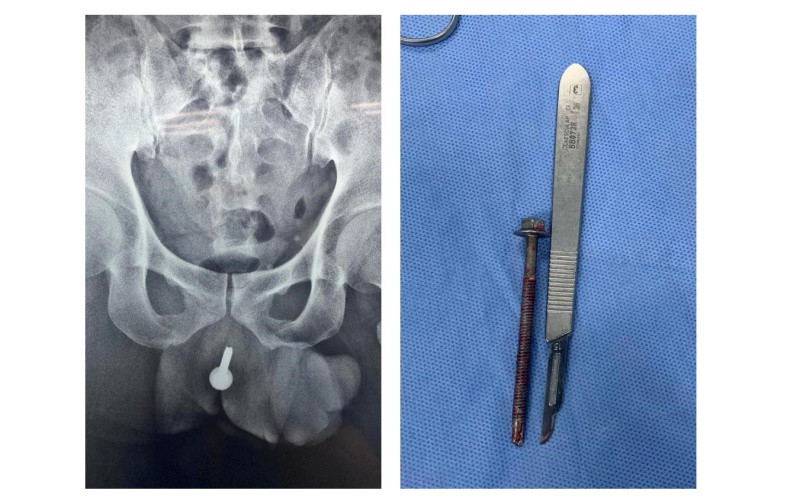 Dị vật dài 6cm, được lấy ra từ niệu đạo người đàn ông. (Ảnh: Bệnh viện cung cấp)