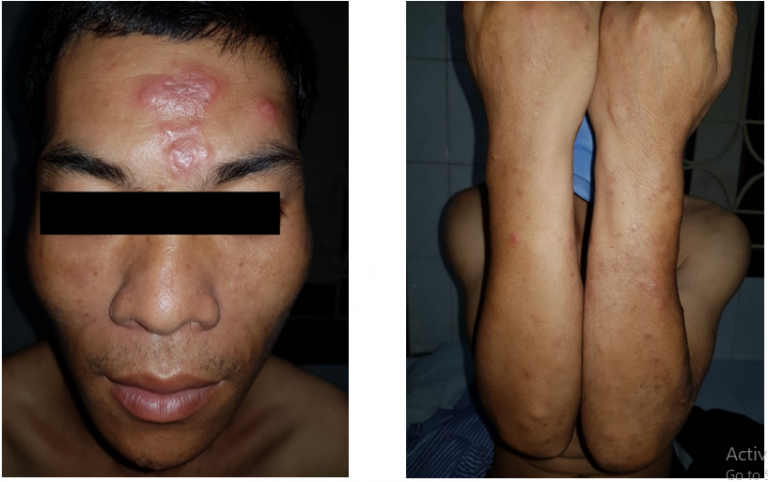 Tổn thương mảng đỏ vùng trán, sẩn đỏ 1 – 2cm rải rác vùng mặt, tay. Mặt mu bàn tay khô, mất bóng. (Ảnh: BVCC)