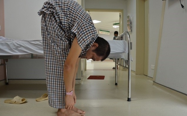 Bệnh nhân gù gập gây khó khăn trong cuộc sống.