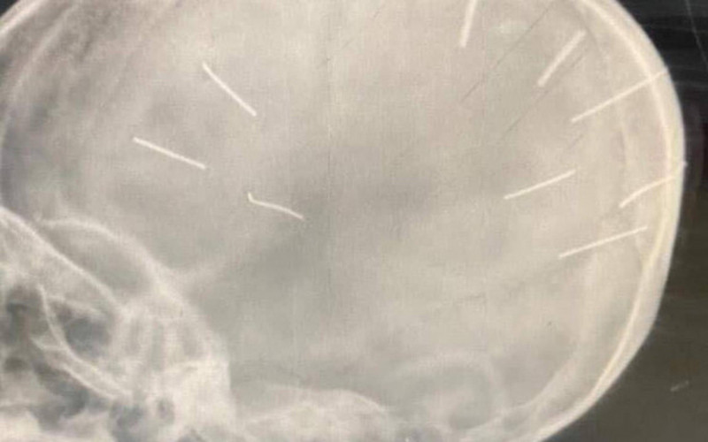 Hình ảnh phim chụp X-quang phát hiện trong hộp sọ cháu bé có nhiều dị vật giống đinh.