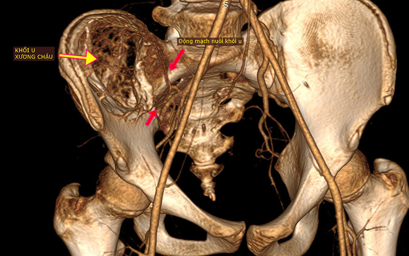 Hình ảnh khối u khổng lồ và hệ thống phức tạp mạch máu nuôi u.