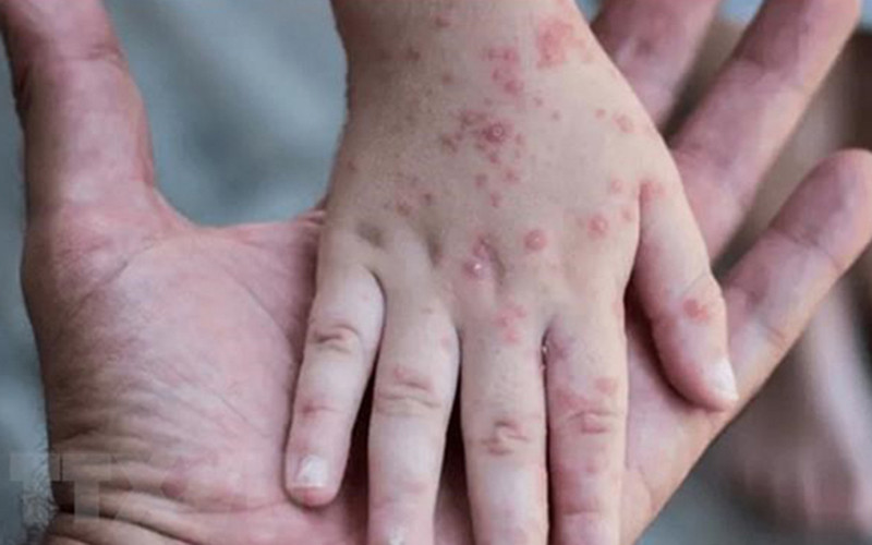 Một em nhỏ mắc bệnh đậu mùa khỉ tại Israel. (Ảnh: Reuters/TTXVN)