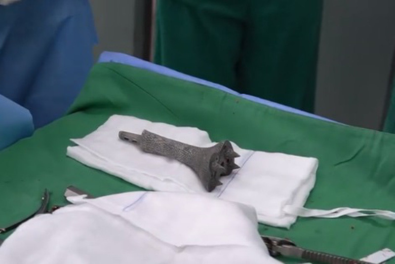 Mảnh ghép titanium in 3D thay thế xương chày cho bệnh nhân. (Ảnh: BVCC)