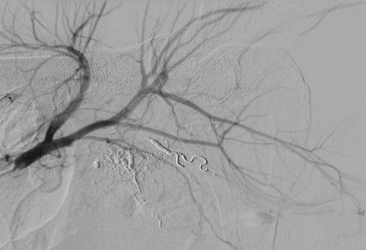 Sau nút mạch quanh động mạch trực tràng. (Ảnh: BVCC)