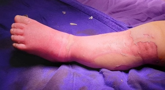 Biến chứng do đắp lá chữa bỏng nước sôi cho trẻ