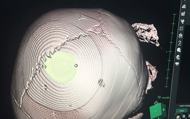 Hình ảnh chụp vết thương sọ não của bé 3 tuổi. (Ảnh: Bác sĩ cung cấp)