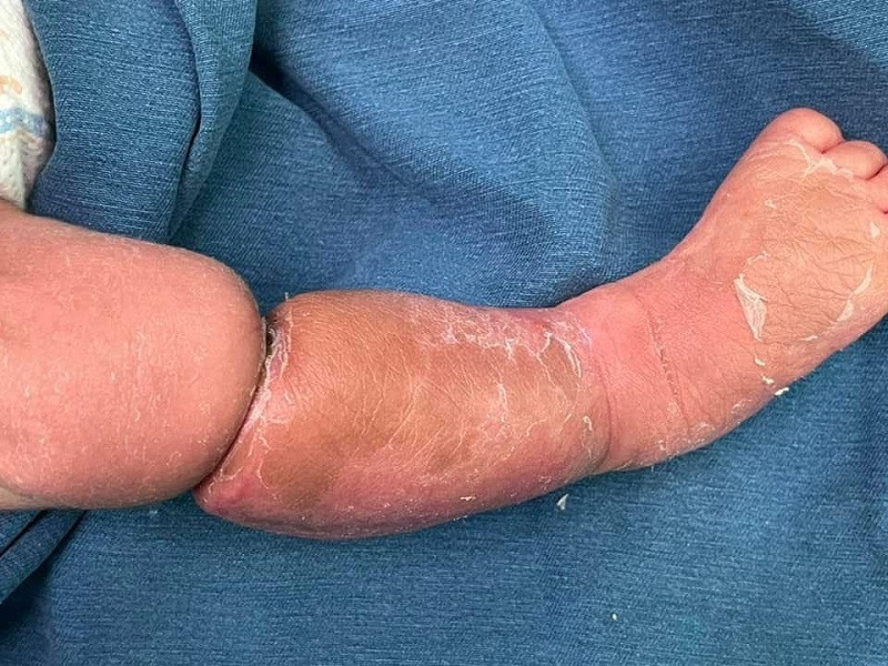 Vòng thắt bẩm sinh ở bé trai.