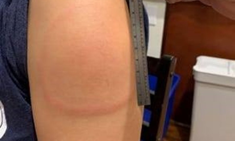 Vết phát ban cánh tay dài 15cm ở người tiêm vaccine Moderna. Đây là triệu chứng vô hại. (Ảnh: Mass General Brigham Hospital)