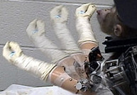 Điều khiển chân tay giả bằng tín hiệu thần kinh