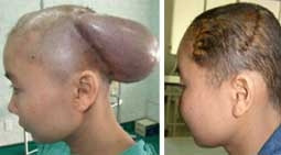 Rụng tóc, hói đầu: Đã có cách chữa