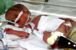 Thừa Thiên- Huế:  Cứu sống bệnh nhi nặng 0,8kg bị đứt ruột non