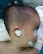 Cháu V.X.T, 3 tháng tuổi,
bị não úng thủy trước
giờ phẫu thuật.