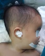 Cháu V.X.T, 3 tháng tuổi,
bị não úng thủy trước
giờ phẫu thuật.