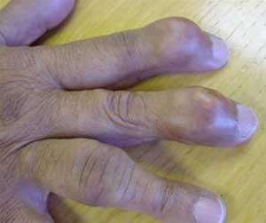 Ai dễ bị bệnh gút?