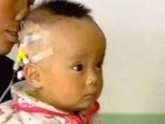 Một em bé là nạn nhân
của sữa nhiễm melamine.