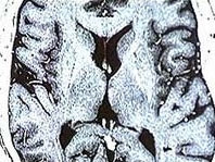 Tìm thấy nơi điều khiển giấc mơ trong não bộ