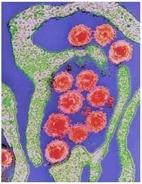 Virus Human herpes 6 (HHV-6).