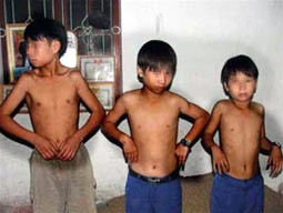 58 trẻ ở Hải Dương nghi mắc bệnh teo cơ delta