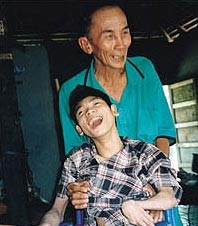 Kiệt bị dị dạng vì nhiễm chất độc da cam.