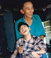 Kiệt bị dị dạng vì nhiễm chất độc da cam.