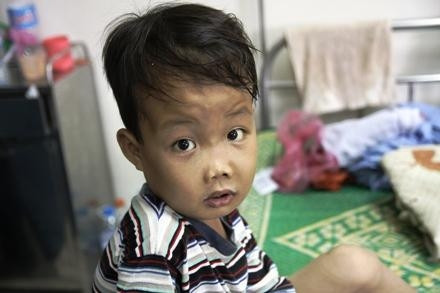 Bé Bàn Quốc Tần bị biến dạng xương nửa đầu khi bệnh đã ở thể nặng.