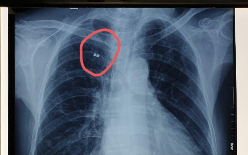 Vị trí mảnh bom trước khi gắp ra. (Ảnh: BVCC)