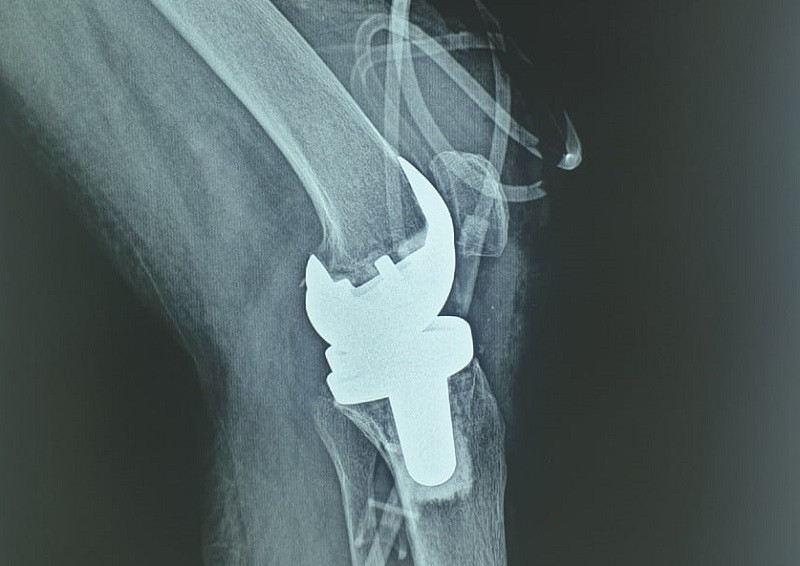 Bệnh nhân mắc lao khớp gối được thay khớp thành công. 