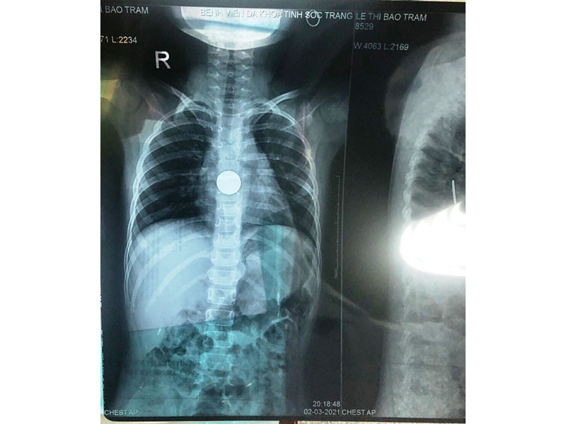 Hình ảnh dị vật đồng xu khi bé T mới nhập viện.