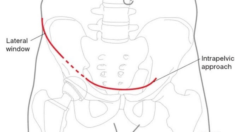 Đường mổ Stoppa cải tiến được sử dụng trong phẫu thuật anh-bv-y-duocn800.jpg