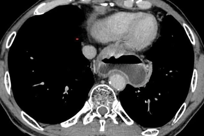 Hình ảnh tổn thương ống dạ dày trên chụp cắt lớp vi tính. (Ảnh: BVCC)