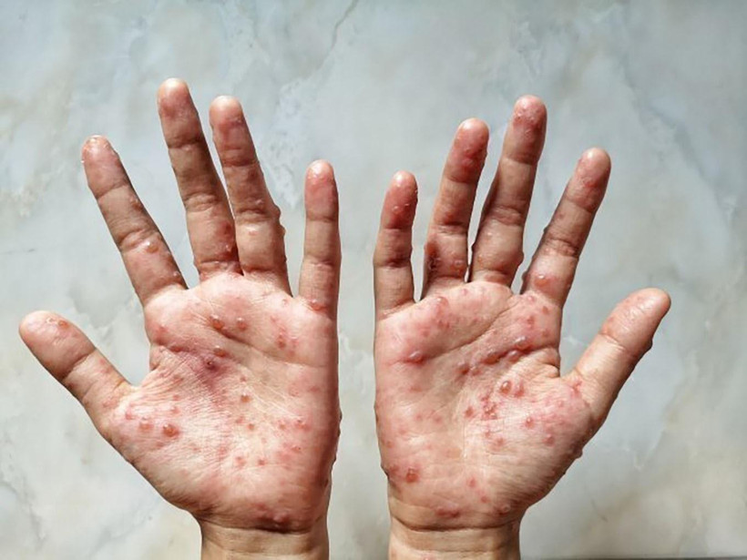 Các ban đỏ nổi trên tay 1 bệnh nhân mắc đậu mùa khỉ. (Ảnh: Shutterstock/TTXVN)
