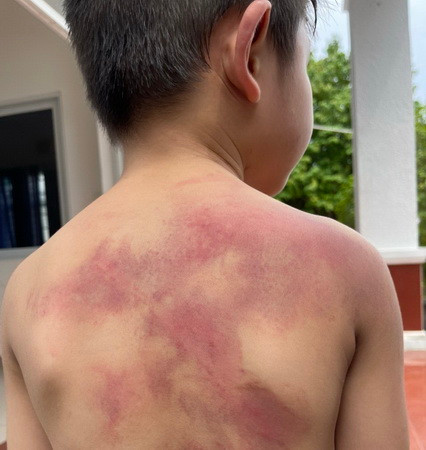 Cháu Đ bị nhiều vết bầm tím trên cơ thể do cha đánh.