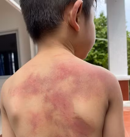 Cháu Đ bị nhiều vết bầm tím trên cơ thể do cha đánh.