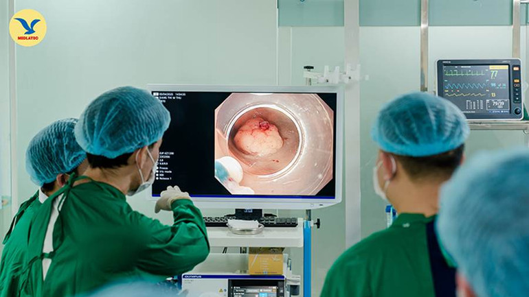 Chuyên gia MEDLATEC thực hiện kỹ thuật ESD điều trị sớm ung thư đại tràng cho bệnh nhân.