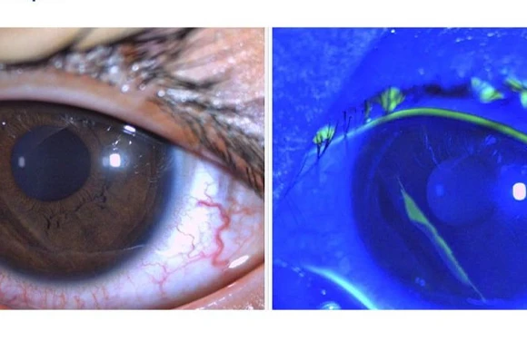 Hình ảnh trợt biểu mô giác mạc ở bệnh nhi 4 tuổi qua quan sát bằng sinh hiển vi có nhuộm soi Fluorescein (ảnh phải).