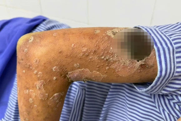 Bệnh nhân được điều trị tích cực tại Bệnh viện Da liễu Trung ương. (Ảnh: BVCC)