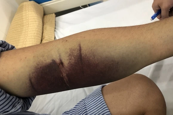 Bệnh nhân đang điều trị tại Bệnh viện Nội tiết Trung ương. 