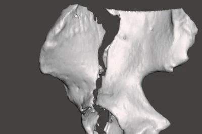 Hình ảnh dựng hình 3D ổ gãy xương chậu hỗ trợ lập kế hoạch phẫu thuật.