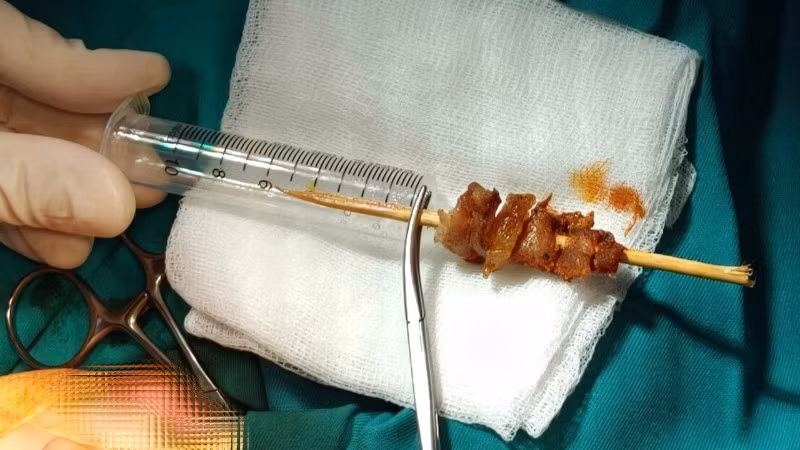 Dị vật gây tổn thương nghiêm trọng cho cháu bé. 