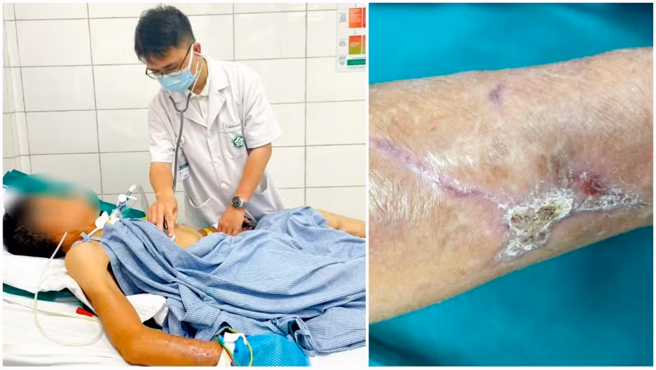 Bệnh nhân nằm điều trị tại Bệnh viện Bạch Mai do uốn ván. 