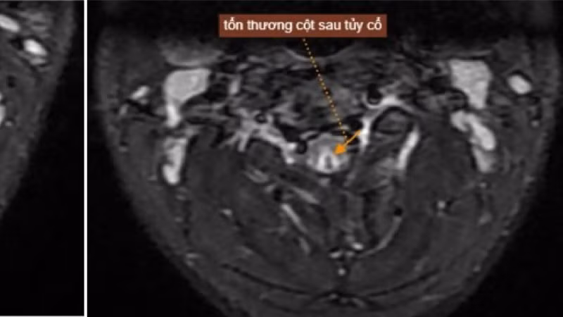 Tổn thương của nam thanh niên sau khi hút bóng cười. 