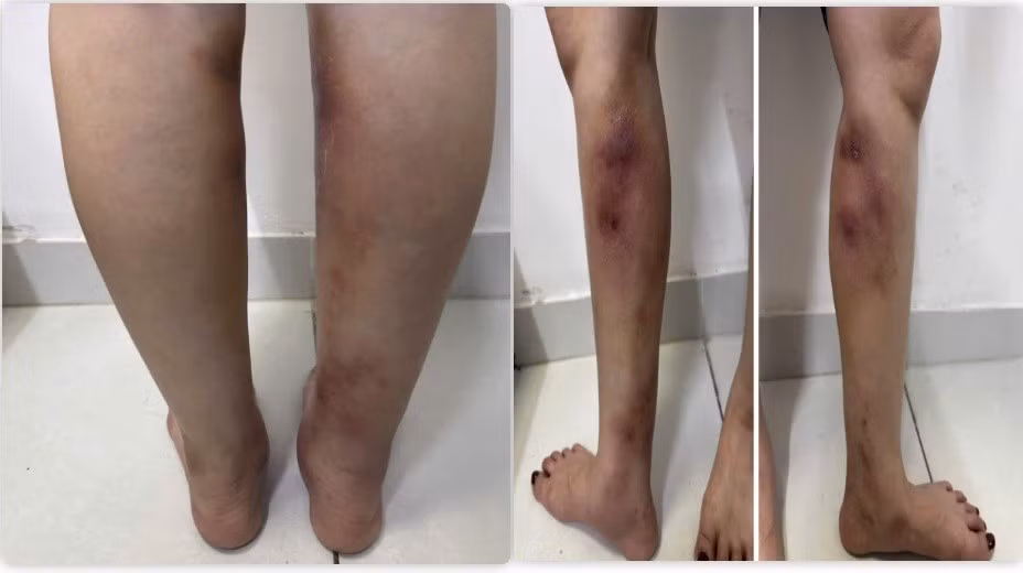 Hình ảnh tổn thương của người bệnh. 