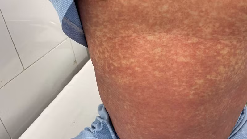 Hình ảnh người bệnh bị dị ứng với thuốc Phenylbutazone.
