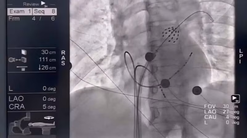 Hình ảnh catheter triệt đốt trong buồng tim, phát xung điện cô lập tĩnh mạch phổi.