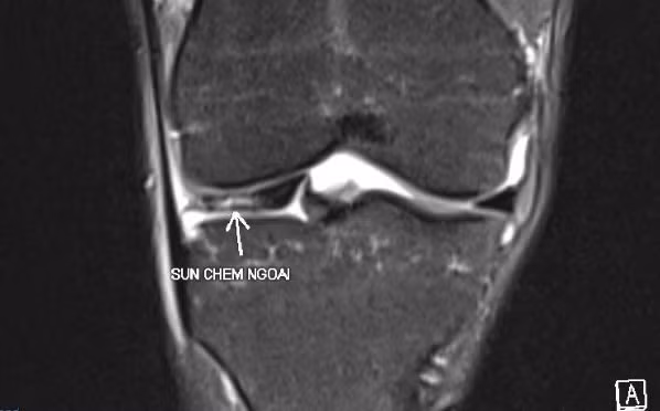 chup-mri-cho-thay-ton-thuong-rach-sun-chem.jpg