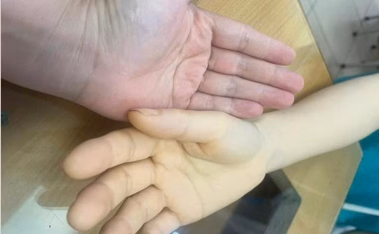 Bàn tay bệnh nhân (bên phải) vàng da vì mất máu. 