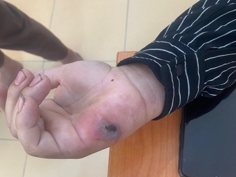 Biểu hiện bệnh than trên cơ thể người bệnh tại Tủa Chùa.