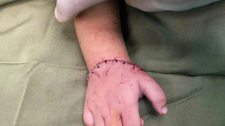 Bàn tay cháu bé được nối liền sau khi đứt rời.